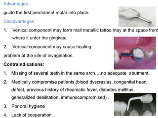 Advantages :
guide the first permanent molar into place.
Disadvantages :
1. Vertical component may form mall metallic tattoo may at the space from
where it enter the gingivae.
2. Vertical component may cause healing
problem at the site of invagination.
Contraindications:
1. Missing of several teeth in the same arch….no adequate abutment.
2. Medically compromise patients (blood dyscrasias, congenital heart
defect, previous history of rheumatic fever, diabetes mellitus,
generalized debilitation, immunocompromised) .
3. Por oral hygiene
4. Lack of cooperation
 