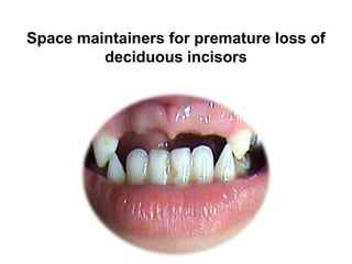 Space maintainers for premature loss of
deciduous incisors
 