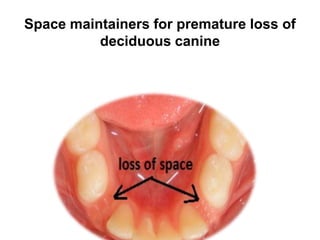 Space maintainers for premature loss of
deciduous canine
 