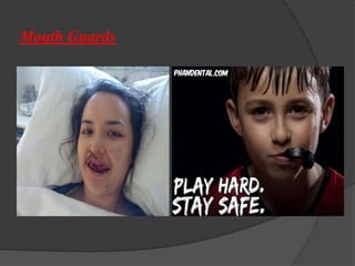 Mouth Guards
 