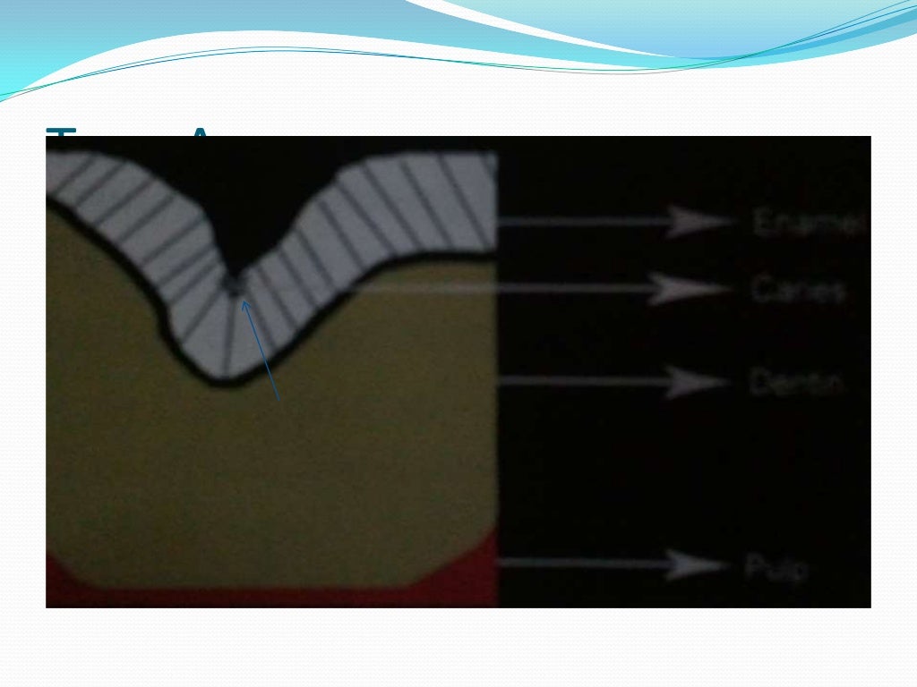 Preventive resin restoration ppt