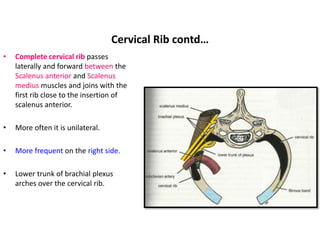 Right Complete Cervical Rib prevertebral_region.pptx