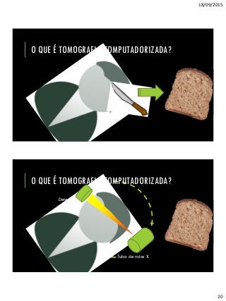 18/09/2015
20
O QUE É TOMOGRAFIA COMPUTADORIZADA?
http://ligiadantas.com.br/wp-
content/uploads/2013/10/Integralde-forma-light_fatia-de-
.25g_54cal.jpg
O QUE É TOMOGRAFIA COMPUTADORIZADA?
http://ligiadantas.com.br/wp-
content/uploads/2013/10/Integralde-forma-light_fatia-de-
.25g_54cal.jpg
Tubo de raios X
Detector
 
