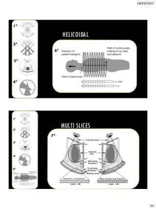 18/09/2015
35
HELICOIDAL
6ª
4ª
3ª
2ª
1ª
MULTI SLICES
6ª
4ª
3ª
2ª
1ª
7ª
 