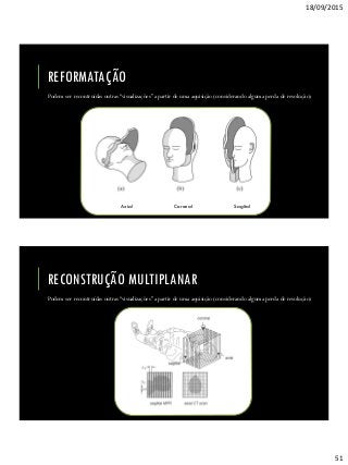 18/09/2015
51
REFORMATAÇÃO
Podem ser recontruídas outras “visualizações” a partir de uma aquisição (considerando alguma perda de resolução)
Axial Coronal Sagital
RECONSTRUÇÃO MULTIPLANAR
Podem ser recontruídas outras “visualizações” a partir de uma aquisição (considerando alguma perda de resolução)
 