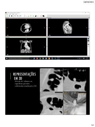 18/09/2015
52
Seleção de volumes ou
superfícies permite
sofisticadas visualizações 3D
REPRESENTAÇÕES
EM 3D
 