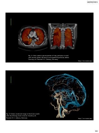 18/09/2015
66
Fig. 2: Color-coded superimposition of lung perfusion in axial
and coronal planes showing a sub-segmental perfusion defect.
Courtesy of: Thorsten R. C. Johnson, Germany
http://www.dsct.com/
Fig. 3: Volume-rendered image of the brain vessels
after Dual Energy bone removal. Courtesy of:
Thorsten R. C. Johnson, Germany http://www.dsct.com/
 