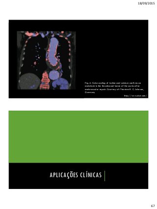 18/09/2015
67
Fig. 4: Color-coding of iodine and calcium confirms an
endoleak in the thrombosed lumen of the aorta after
endovascular repair. Courtesy of: Thorsten R. C. Johnson,
Germany
http://www.dsct.com/
APLICAÇÕES CLÍNICAS
 