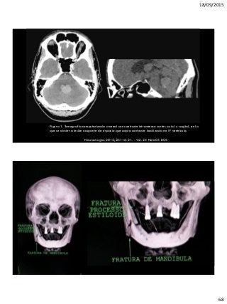 18/09/2015
68
Figura 1. Tomografía computarizada craneal con contraste intravenoso cortes axial y sagital, en la
que se observa lesión ocupante de espacio que capta contraste localizada en IV ventrículo.
Neurocirugia. 2012;23:116-21. - Vol. 23 Núm.03 DOI:
10.1016/j.neucir.2011.02.001
 