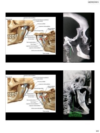 18/09/2015
69
http://3.bp.blogspot.com/_p9YknW3sIxs/TTCKht4mWfI/AAAA
AAAABPI/SIEV4_xl2DE/s1600/Processo%2Bestiloide%2B1.jpg
 