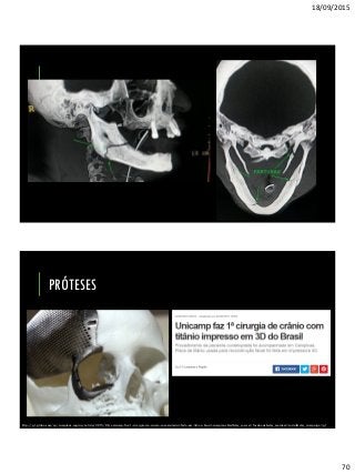 18/09/2015
70
PRÓTESES
http://g1.globo.com/sp/campinas-regiao/noticia/2015/06/unicamp-faz-1-cirurgia-de-cranio-com-material-feito-em-3d-no-brasil-campinas.html?utm_source=facebook&utm_medium=social&utm_campaign=g1
 