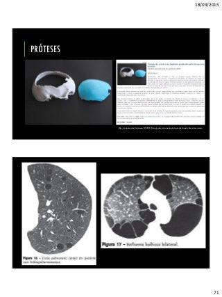 18/09/2015
71
PRÓTESES
http://unan.unesp.br/destaques/0/19099/Cirurgia-de-cranio-com-implante-produzido-pela-Unesp-tem-sucesso
 