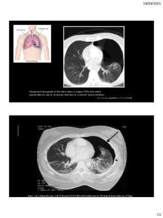 18/09/2015
73
Computed tomograph of the chest shows a large (70%) left-sided
pneumothorax due to erroneous insertion of a central venous catheter.
Am J Crit Care July 2006 vol. 15 no. 4 415-419
http://pt.wikipedia.org/wiki/Pneumot%C3%B3rax#mediaviewer/Ficheiro:Pneumothorax_CT.jpg
 