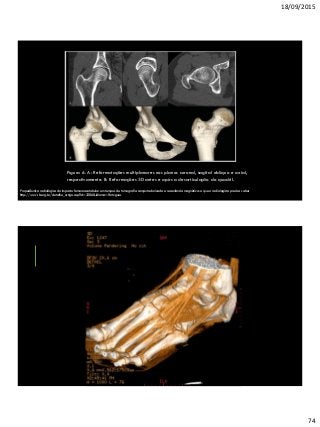 18/09/2015
74
Figura 6. A: Reformatações multiplanares nos planos coronal, sagital oblíquo e axial,
respectivamente. B: Reformações 3D antes e após a desarticulação do quadril.
Propedêutica radiológica do impacto femoroacetabular em tempos de tomografia computadorizada e ressonância magnética: o que o radiologista precisa saber
http://www.rb.org.br/detalhe_artigo.asp?id=2206&idioma=Portugues
Propedêutica radiológica do impacto femoroacetabular em tempos de tomografia
computadorizada e ressonância magnética: o que o radiologista precisa saber
 