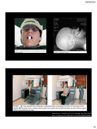 18/09/2015
76
Dental Press J. Orthod. vol.15 no.1 Maringá Jan./Feb. 2010
http://dx.doi.org/10.1590/S2176-94512010000100006
 