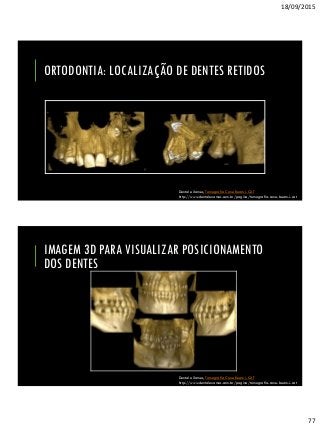 18/09/2015
77
ORTODONTIA: LOCALIZAÇÃO DE DENTES RETIDOS
Dental eXames, Tomografia Cone Beam i-CAT
http://www.dentalexames.com.br/pagina/tomografia-cone-beam-i-cat
IMAGEM 3D PARA VISUALIZAR POSICIONAMENTO
DOS DENTES
Dental eXames, Tomografia Cone Beam i-CAT
http://www.dentalexames.com.br/pagina/tomografia-cone-beam-i-cat
 
