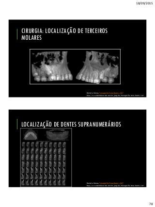 18/09/2015
78
CIRURGIA: LOCALIZAÇÃO DE TERCEIROS
MOLARES
Dental eXames, Tomografia Cone Beam i-CAT
http://www.dentalexames.com.br/pagina/tomografia-cone-beam-i-cat
LOCALIZAÇÃO DE DENTES SUPRANUMERÁRIOS
Dental eXames, Tomografia Cone Beam i-CAT
http://www.dentalexames.com.br/pagina/tomografia-cone-beam-i-cat
 