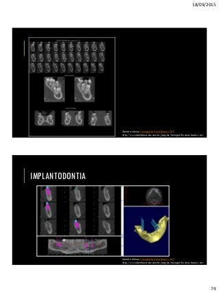 18/09/2015
79
Dental eXames, Tomografia Cone Beam i-CAT
http://www.dentalexames.com.br/pagina/tomografia-cone-beam-i-cat
IMPLANTODONTIA
Dental eXames, Tomografia Cone Beam i-CAT
http://www.dentalexames.com.br/pagina/tomografia-cone-beam-i-cat
 