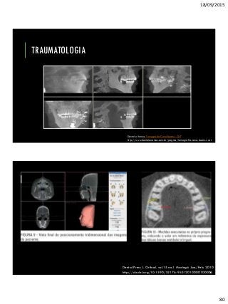 18/09/2015
80
TRAUMATOLOGIA
Dental eXames, Tomografia Cone Beam i-CAT
http://www.dentalexames.com.br/pagina/tomografia-cone-beam-i-cat
Dental Press J. Orthod. vol.15 no.1 Maringá Jan./Feb. 2010
http://dx.doi.org/10.1590/S2176-94512010000100006
 