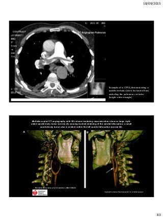 18/09/2015
83
Example of a CTPA, demonstrating a
saddle embolus (dark horizontal line)
occluding the pulmonary arteries
(bright white triangle)
Multislice spiral CT angiography with 3D volume-rendering reconstruction shows a large, right-
sided carotid body tumor (arrow) (A) causing marked widening of the carotid bifurcation; a small
carotid body tumor also is evident within the left carotid bifurcation (arrow) (B).
Riccardo Iannaccone et al. Circulation. 2004;109:e64
Copyright © American Heart Association, Inc. All rights reserved.
 