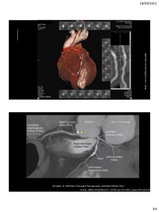 18/09/2015
84
http://www.isnjllc.com/ct-scan.php
Example of Multislice Computed Tomography, Unfolded Globe View
JAMA. 2005;293(20):2471-2478. doi:10.1001/jama.293.20.2471.
 