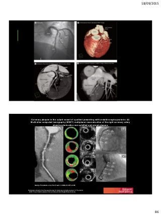 18/09/2015
86
Coronary plaques in the culprit vessel of a patient presenting with unstable angina pectoris: (A)
Multi-slice computed tomography (MSCT) multiplanar reconstruction of the right coronary artery
showing obstructive non-calcified and mixed plaques.
Gabija Pundziute et al. Eur Heart J 2008;29:2373-2381
Published on behalf of the European Society of Cardiology. All rights reserved. © The Author
2008. For permissions please email: journals.permissions@oxfordjournals.org
 