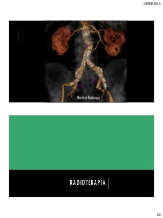 18/09/2015
88
RADIOTERAPIA
 