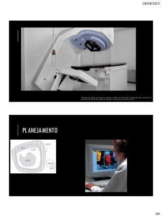 18/09/2015
89
A Radioterapia Guiada Por Imagem no Tratamento do Câncer de Próstata http://radiologia.blog.br/radioterapia/a-
importancia-da-radioterapia-guiada-por-imagem-no-tratamento-do-cancer-de-prostata
PLANEJAMENTO
 