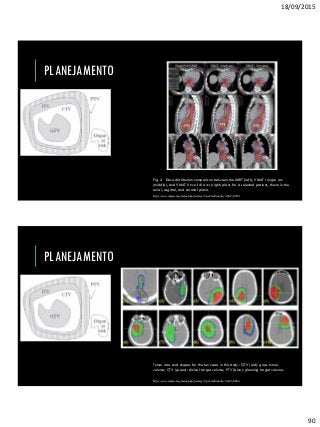 18/09/2015
90
PLANEJAMENTO
Fig. 4 Dose distribution comparison between the IMRT (left), VMAT I single arc
(middle), and VMAT II two full arcs (right) plans for a selected patient, shown in the
axial, sagittal, and coronal plane.
http://www.jacmp.org/index.php/jacmp/rt/printerFriendly/4269/2933
PLANEJAMENTO
Tumor sites and shapes for the ten cases in this study: GTV (red): gross tumor
volume; CTV (green): clinical target volume; PTV (blue): planning target volume.
http://www.jacmp.org/index.php/jacmp/rt/printerFriendly/3422/2264
 