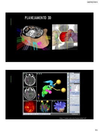 18/09/2015
91
PLANEJAMENTO 3D
http://radonc.ucla.edu/body.cfm?id=67
 
