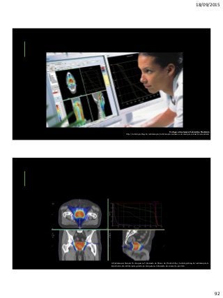 18/09/2015
92
Conheça a Arcoterapia Volumétrica Modulada
http://radiologia.blog.br/radioterapia/radioterapia-conheca-a-arcoterapia-volumetrica-modulada
A Radioterapia Guiada Por Imagem no Tratamento do Câncer de Próstata http://radiologia.blog.br/radioterapia/a-
importancia-da-radioterapia-guiada-por-imagem-no-tratamento-do-cancer-de-prostata
 