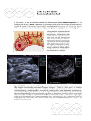 O Tubo Digestivo Normal – 
A Assinatura Gastrointestinal 
O trato digestivo é um tubo oco contínuo do esôfago ao reto, todo ele composto de cinco camadas concêntricas (Fig. 1). Do 
lúmen para fora, são elas: (1) mucosa, a qual consiste em revestimento epitelial, tecido conectivo frouxo ou lâmina própria; (2) 
muscular da mucosa; (3) submucosa; (4) duas camadas de muscular própria (a mais interna, onde as fibras estão dispostas 
de forma circular, e a mais externa, onde as fibras estão dispostas longitudinalmente); e (5) serosa e adventícia (Fig. 2). 1,2,3 
16 
Ultrassonografia e Doppler do Trato Gastrointestinal - Lucy Kerr - Todos os direitos reservados 
1 
2A 2B 
Figuras 2A, 2B. US da assinatura gastrointestinal. A imagem 2A, à esquerda, mostra a parede do antro gástrico com estômago minima-mente 
preenchido com o líquido para mostrar a separação entre as duas paredes; e a imagem 2B, à direita, mostra o íleo terminal na 
cavidade pélvica pela via transvaginal ao longo do maior eixo da alça. Em ambas as imagens, são mostradas as cinco camadas concêntri-cas 
justapostas: mucosa, a mais interna, ecogênica, coincidindo com a posição dos calipers, seguida da muscular da mucosa, muito fina, 
quase imperceptível e hipoecogênica, da submucosa, camada mais espessa e ecogênica, da muscular própria (composta de duas camadas 
hipoecogênicas separadas por uma fina camada ecogênica de tecido fibroso, não se distinguindo as fibras circulares mais internas da mais 
externas, onde as fibras estão dispostas longitudinalmente. Uma finíssima camada ecogênica separa a camada muscular própria longitu-dinal 
da circular. A camada mais externa e ecogênica, composta pela serosa e a adventícia, reveste a alça e é mais facilmente identificável 
onde está posicionado o segundo caliper. Toda a espessura da parede gástrica mede, em A, 4,4 mm (estômago normal ≤ 5mm) e 1,6 mm 
em B (intestino normal ≤ 3 mm). 
Fonte: NETTER, 1962 
Figura 1. Desenho de alça intestinal dissecada 
mostrando as cinco camadas concêntricas jus-tapostas: 
mucosa (a mais interna e em contato 
com lúmen intestinal), seguida da muscular da 
mucosa (muito fina, quase imperceptível, na 
base da mucosa), da submucosa (camada mais 
espessa e disposta em desenho granuloso como 
o favo de mel), da muscular própria (composta 
de duas camadas, a mais interna, onde as fibras 
estão dispostas de forma circular, e a mais ex-terna, 
onde as fibras estão dispostas longitudi-nalmente 
e separadas por uma fina camada de 
tecido fibroso), da serosa e da adventícia (ca-mada 
mais externa, que reveste a alça). 
 