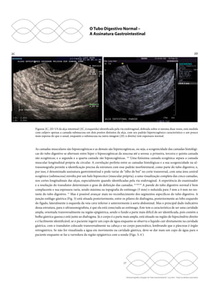 O Tubo Digestivo Normal – 
A Assinatura Gastrointestinal 
2C 2D 
Figuras 2C, 2D. US da alça intestinal (2C, à esquerda) identificada pela via endovaginal, dobrada sobre si mesma duas vezes, está medida 
com calipers apenas a camada submucosa em dois pontos distintos da alça, com seu padrão hiperecogênico característico e um pouco 
mais espessa do que o usual, enquanto a submucosa na outra imagem (2D, à direita) tem espessura normal. 
As camadas musculares são hipoecogênicas e as demais são hiperecogênicas, ou seja, a ecogenicidade das camadas histológi-cas 
do tubo digestivo se alternam entre hiper e hipoecogênicas da mucosa até a serosa: a primeira, terceira e quinta camada 
são ecogênicas; e a segunda e a quarta camada são hipoecogênicas. 4,5 Uma finíssima camada ecogênica separa a camada 
muscular longitudinal própria da circular. A correlação perfeita entre as camadas histológicas e a sua ecogenicidade na ul-trassonografia 
permite a identificação precisa da estrutura com esse padrão morfotextural, como parte do tubo digestivo, e, 
por isso, é denominado assinatura gastrointestinal e pode variar de “olho de boi” no corte transversal, com uma área central 
ecogênica (submucosa) envolta por um halo hipoecoico (muscular própria), a uma visualização completa das cinco camadas, 
nos cortes longitudinais das alças, especialmente quando identificadas pela via endovaginal. A experiência do examinador 
e a resolução do transdutor determinam o grau de definição das camadas. 6,7,8,9,10 A parede do tubo digestivo normal é bem 
complacente e sua espessura varia, sendo máxima na topografia do estômago (5 mm) e reduzida para 3 mm a 4 mm no res-tante 
do tubo digestivo. 11 Mas é possível avançar mais no reconhecimento dos segmentos específicos do tubo digestivo. A 
junção esôfago-gástrica (Fig. 3) está situada posteriormente, entre os pilares do diafragma, posteriormente ao lobo esquerdo 
do fígado, lateralmente à esquerda da veia cava inferior e anteriormente à aorta abdominal. Mas o principal dado indicativo 
dessa estrutura, para o ultrassonografista, é que ela está conectada ao estômago. Este tem a característica de ser uma cavidade 
ampla, orientada transversalmente na região epigástrica, sendo o fundo a parte mais difícil de ser identificada, pois contém a 
bolha gástrica gasosa e está junto ao diafragma. Já o corpo é a parte mais ampla, está situado na região do hipocôndrio direito 
e é facilmente identificável, se o paciente ingerir um copo de água enquanto se observa o líquido cair diretamente na cavidade 
gástrica, com o transdutor colocado transversalmente na cabeça e no corpo pancreático, lembrando que o pâncreas é órgão 
retrogástrico. Se não for visualizada a água em movimento na cavidade gástrica, deve-se dar mais um copo de água para o 
paciente enquanto se faz a varredura da região epigástrica com a sonda (Figs. 3, 4 ). 
17 
Ultrassonografia e Doppler do Trato Gastrointestinal - Lucy Kerr - Todos os direitos reservados 
 