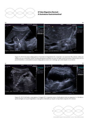 O Tubo Digestivo Normal – 
A Assinatura Gastrointestinal 
3A 3B 
Figuras 3A, 3B. US de junção esôfago-gástrica. É mostrada em longitudinal (3A, à esquerda) e em transversal (3B, à direita), ambas assi-naladas 
com seta e mostrando o lúmen com partículas gasosas mescladas com muco na região central da estrutura. Observar que, em 3A, é 
possível identificar a continuidade da junção esôfago-gástrica (setas) com o estômago, que contém líquido no seu interior. 
3C 3D 
Figuras 3C, 3D. US de fundo e corpo gástrico. A imagem (3C, à esquerda) mostra o fundo gástrico junto aos segmentos 2 e 3 do lobo es-querdo 
do fígado, em secção longitudinal, e corpo gástrico distendido por líquido no hipocôndrio esquerdo (3D, à direita). 
18 
Ultrassonografia e Doppler do Trato Gastrointestinal - Lucy Kerr - Todos os direitos reservados 
 