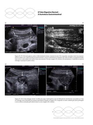 O Tubo Digestivo Normal – 
A Assinatura Gastrointestinal 
3E 3F 
Figuras 3E, 3F. US de antro gástrico, piloro e bulbo duodenal normais. A porção do antro (3E, à esquerda), mais plana (setas retas maiores), 
está em contato com a cabeça do pâncreas posteriormente e conecta-se diretamente ao duodeno, que exibe sua bolha na topografia do bulbo 
(seta curva), e, entre ambos, está o piloro (setas retas menores). Na outra imagem (3F, à direita), um estreitamento é visualizado na saída do 
estômago, na projeção do piloro (setas). 
3G 3H 
Figuras 3G, 3H. US de estômago normal. As dobras do corpo e fundo gástrico não são habitualmente identificáveis, mas podem ser vistas 
em estômago (setas) distendido por pequena quantidade de líquido na imagem (3G, à esquerda) ou muito colabado pelo jejum prolongado 
e com as dobras acentuadas pelo edema (setas) na outra imagem (3H, à direita). 
19 
Ultrassonografia e Doppler do Trato Gastrointestinal - Lucy Kerr - Todos os direitos reservados 
 