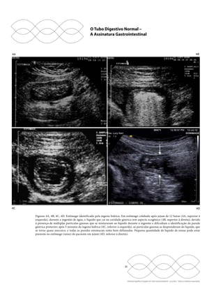 4B 
Figuras 4A, 4B, 4C, 4D. Estômago identificado pela ingesta hídrica. Em estômago colabado após jejum de 12 horas (4A, superior à 
esquerda), durante a ingestão de água, o líquido que cai na cavidade gástrica tem aspecto ecogênico (4B, superior à direita), devido 
à presença de múltiplas partículas gasosas que se misturaram ao líquido durante a ingestão e dificultam a identificação da parede 
gástrica posterior; após 5 minutos da ingesta hídrica (4C, inferior à esquerda), as partículas gasosas se desprenderam do líquido, que 
se torna quase anecoico, e todas as paredes estomacais estão bem delineadas. Pequena quantidade de líquido de estase pode estar 
presente no estômago (setas) do paciente em jejum (4D, inferior à direita). 
20 
Ultrassonografia e Doppler do Trato Gastrointestinal - Lucy Kerr - Todos os direitos reservados 
4A 
4C 
4D 
O Tubo Digestivo Normal – 
A Assinatura Gastrointestinal 
 