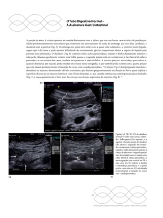 A porção do antro é a mais espessa e se conecta diretamente com o piloro, que tem sua forma característica de paredes pa-ralelas 
predominantemente musculares que promovem um estreitamento da saída do estômago que une duas cavidades, a 
duodenal com a gástrica (Fig. 3). O estômago em jejum deve estar vazio e quase todo colabado e, se contiver muito líquido, 
sugere que é de estase e pode apontar dificuldade do esvaziamento gástrico (importante afastar a ingesta de líquido pelo 
paciente não informada). O duodeno (Fig. 5) contorna toda a cabeça pancreática, estando o bulbo diretamente anterior à 
cabeça do pâncreas, geralmente contém uma bolha gasosa e a segunda porção está em contato com a face lateral da cabeça 
pancreática e, na maioria dos casos, também está posterior à vesícula biliar. A terceira porção é retrocabeça pancreática e, 
quando distendida por líquido, pode simular uma massa nessa topografia, o que também pode ocorrer com a quarta porção 
que está situada posteriormente à transição do corpo com a cauda pancreática. 12 O jejuno (Fig. 6) tem pregueado mais fino e 
abundante da mucosa, denominado válvulas coniventes, que diminui progressivamente em direção ao íleo e quase triplica a 
superfície de contato da mucosa intestinal com o bolo alimentar, e a sua camada submucosa contém poucas placas linfoides 
(Fig. 7) e, consequentemente, é bem mais fina do que nos demais segmentos do intestino (Fig. 8). 12 
5B 5C 
21 
Ultrassonografia e Doppler do Trato Gastrointestinal - Lucy Kerr - Todos os direitos reservados 
5A 
Figuras 5A, 5B, 5C. US de duodeno 
normal. O bulbo (seta curva), conten-do 
a bolha gasosa (5A, superior), e a 
segunda e terceira porção do duodeno 
(5B, inferior à esquerda) são mostra-dos 
contornando a cabeça pancreática, 
estando o bulbo diretamente anterior à 
cabeça do pâncreas e a segunda porção 
(seta horizontal) está em contato com 
a face lateral da cabeça pancreática. A 
terceira porção (seta vertical em 5B e 
seta curva em 5C, inferior à direita) 
é retrocabeça pancreática e a quarta 
porção (setas retas em 5C) está situada 
posteriormente à transição do corpo 
com a cauda pancreática. 
O Tubo Digestivo Normal – 
A Assinatura Gastrointestinal 
 