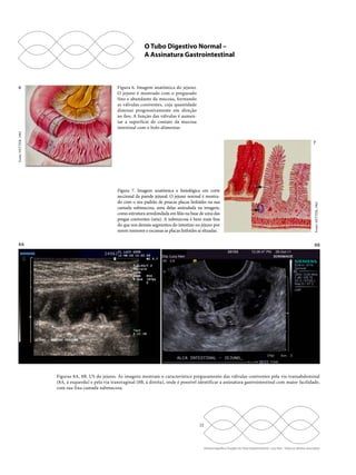O Tubo Digestivo Normal – 
A Assinatura Gastrointestinal 
8A 8B 
Figuras 8A, 8B. US do jejuno. As imagens mostram o característico pregueamento das válvulas coniventes pela via transabdominal 
(8A, à esquerda) e pela via transvaginal (8B, à direita), onde é possível identificar a assinatura gastrointestinal com maior facilidade, 
com sua fina camada submucosa. 
22 
Ultrassonografia e Doppler do Trato Gastrointestinal - Lucy Kerr - Todos os direitos reservados 
6 
7 
Fonte: NETTER, 1962 
Fonte: NETTER, 1962 
Figura 6. Imagem anatômica do jejuno. 
O jejuno é mostrado com o pregueado 
fino e abundante da mucosa, formando 
as válvulas coniventes, cuja quantidade 
diminui progressivamente em direção 
ao íleo. A função das válvulas é aumen-tar 
a superfície de contato da mucosa 
intestinal com o bolo alimentar. 
Figura 7. Imagem anatômica e histológica em corte 
seccional da parede jejunal. O jejuno normal é mostra-do 
com o seu padrão de poucas placas linfoides na sua 
camada submucosa, uma delas assinalada na imagem, 
como estrutura arredondada em lilás na base de uma das 
pregas coniventes (seta). A submucosa é bem mais fina 
do que nos demais segmentos do intestino no jejuno por 
serem menores e escassas as placas linfoides aí situadas. 
 