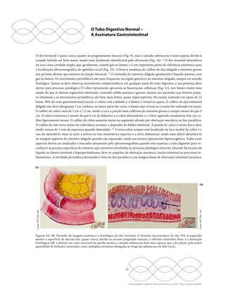 O Tubo Digestivo Normal – 
A Assinatura Gastrointestinal 
O íleo terminal é quase careca quanto ao pregueamento mucoso (Fig. 9), mas a camada submucosa é mais espessa devido à 
camada linfoide ser bem maior, muito mais facilmente identificável pelo ultrassom (Fig. 10). 12 O íleo terminal desemboca 
no ceco, uma cavidade ampla, que, geralmente, contém gás no lúmen, e é um importante ponto de referência anatômico para 
a localização ultrassonográfica do apêndice cecal (Fig. 10). A brusca mudança de calibre da alça delgada e intestino grosso 
nos permite afirmar que estamos na junção ileocecal. 12 O conteúdo do intestino delgado geralmente é líquido-pastoso, sem 
gás no lúmen. Os movimentos peristálticos são mais frequentes na região gástrica e no intestino delgado, sempre em sentido 
fisiológico. Jamais se deve observar movimentos antiperistálticos em qualquer parte do trato digestivo, e sua presença deve 
alertar para processo patológico. O cólon tipicamente apresenta as haustrações colônicas (Fig. 11), tem lúmen muito mais 
amplo do que os demais segmentos intestinais, conteúdo sólido-pastoso e gasoso, mesmo nos pacientes que fizerem prepa-ro 
intestinal, e os movimentos peristálticos são bem mais lentos, quase imperceptíveis. No exame realizado em jejum de 12 
horas, 90% do trato gastrointestinal (exceto o cólon) está colabado e o lúmen é virtual ou quase. O calibre da alça intestinal 
delgada não deve ultrapassar 3 cm, embora, na maior parte das vezes, o lúmen seja virtual, se o exame for realizado em jejum. 
O calibre do cólon varia de 5 cm a 7,5 cm, sendo o ceco a porção mais calibrosa do intestino grosso e sempre menor do que 9 
cm. O cólon transverso é menor do que 6 cm de diâmetro e o cólon descendente e o cólon sigmoide usualmente têm um ca-libre 
ligeiramente menor. O calibre do cólon aumenta muito no segmento afetado por obstrução mecânica ou íleo paralítico. 
O calibre do reto varia muito em indivíduos normais, a depender do hábito intestinal. A parede do cólon é muito fina e deve 
medir menos de 3 mm de espessura quando distendido. 4,5 O mesocólon sempre está localizado na face medial do cólon e a 
raiz do mesentério situa-se entre a artéria ou veia mesentérica superior e a aorta abdominal, sendo mais difícil identificá-lo 
na margem superior do intestino delgado quando não espessado, sendo sua textura tipicamente hiperecogênica. Todos esses 
aspectos devem ser analisados e buscados ativamente pelo ultrassonografista quando este examina o trato digestivo para re-conhecer 
as porções específicas do intestino que estiverem envolvidas no processo patológico descrito. Quando há excesso de 
líquido no lúmen intestinal e hiperperistaltismo, deve-se suspeitar de obstrução mecânica, torção intestinal ou processos in-flamatórios. 
A atividade peristáltica diminuída é vista em íleo paralítico e em estágios finais de obstrução intestinal mecânica. 
23 
9B 
Fonte: NETTER, 1962 
Ultrassonografia e Doppler do Trato Gastrointestinal - Lucy Kerr - Todos os direitos reservados 
9A 
Fonte: NETTER, 1962 
Figuras 9A, 9B. Desenho da imagem anatômica e histológica do íleo terminal. O desenho macroscópico do íleo (9A, à esquerda) 
mostra a superfície da mucosa lisa, quase careca, devido ao escasso pregueado mucoso, e válvulas coniventes finas; e a ilustração 
histológica (9B, à direita) em corte seccional da parede mostra a camada submucosa bem mais espessa que a do jejuno, pela maior 
quantidade de linfoides, mostrados como múltiplas estruturas alongadas ao longo da submucosa em lilás (seta). 
 