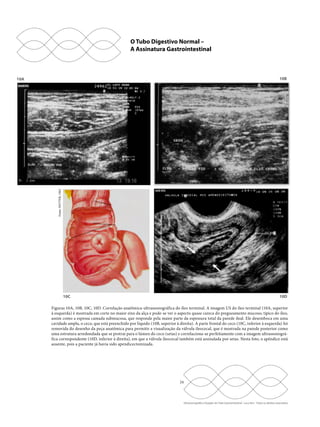 O Tubo Digestivo Normal – 
A Assinatura Gastrointestinal 
24 
Ultrassonografia e Doppler do Trato Gastrointestinal - Lucy Kerr - Todos os direitos reservados 
10A 
10C 
10B 
10B 
10D 
Fonte: NETTER, 1962 
Figuras 10A, 10B, 10C, 10D. Correlação anatômica-ultrassonográfica do íleo terminal. A imagem US do íleo terminal (10A, superior 
à esquerda) é mostrada em corte no maior eixo da alça e pode-se ver o aspecto quase careca do pregueamento mucoso, típico do íleo, 
assim como a espessa camada submucosa, que responde pela maior parte da espessura total da parede ileal. Ele desemboca em uma 
cavidade ampla, o ceco, que está preenchido por líquido (10B, superior à direita). A parte frontal do ceco (10C, inferior à esquerda) foi 
removida do desenho da peça anatômica para permitir a visualização da válvula ileocecal, que é mostrada na parede posterior como 
uma estrutura arredondada que se protrai para o lúmen do ceco (setas) e correlaciona-se perfeitamente com a imagem ultrassonográ-fica 
correspondente (10D, inferior à direita), em que a válvula ileocecal também está assinalada por setas. Nesta foto, o apêndice está 
ausente, pois a paciente já havia sido apendicectomizada. 
 