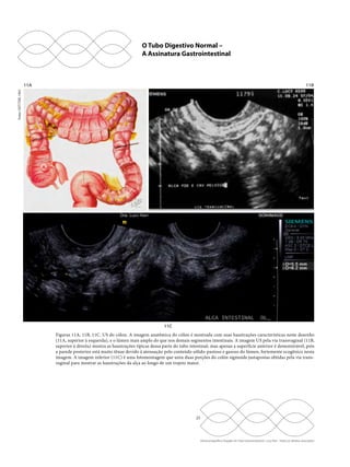 25 
Ultrassonografia e Doppler do Trato Gastrointestinal - Lucy Kerr - Todos os direitos reservados 
11A 
11C 
11B 
Figuras 11A, 11B, 11C. US do cólon. A imagem anatômica do cólon é mostrada com suas haustrações características neste desenho 
(11A, superior à esquerda), e o lúmen mais amplo do que nos demais segmentos intestinais. A imagem US pela via transvaginal (11B, 
superior à direita) mostra as haustrações típicas dessa parte do tubo intestinal, mas apenas a superfície anterior é demonstrável, pois 
a parede posterior está muito tênue devido à atenuação pelo conteúdo sólido-pastoso e gasoso do lúmen, fortemente ecogênico nesta 
imagem. A imagem inferior (11C) é uma fotomontagem que uniu duas porções do colón sigmoide justapostas obtidas pela via trans-vaginal 
para mostrar as haustrações da alça ao longo de um trajeto maior. 
Fonte: NETTER, 1962 
O Tubo Digestivo Normal – 
A Assinatura Gastrointestinal 

