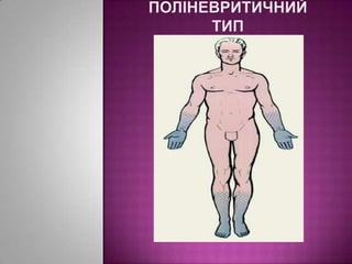 Поліневритичний тип