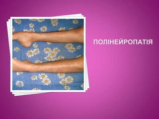 полінейропатія
