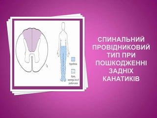 Спинальний провідниковий тип при пошкодженні задніх канатиків