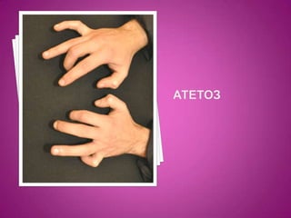 атетоз