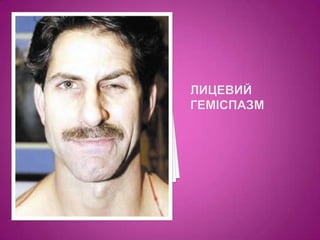 лицевий геміспазм