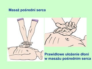 Masaż pośredni serca




                   Prawidłowe ułożenie dłoni
                   w masażu pośrednim serca
 