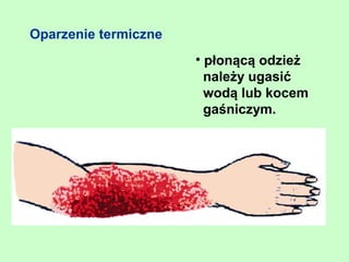 Oparzenie termiczne
                      • płonącą odzież
                        należy ugasić
                        wodą lub kocem
                        gaśniczym.
 