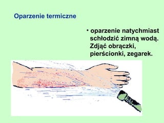 Oparzenie termiczne

                      • oparzenie natychmiast
                        schłodzić zimną wodą.
                        Zdjąć obrączki,
                        pierścionki, zegarek.
 