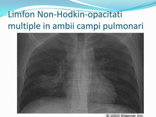 Limfon Prezentare noduli pulmonari | PPTX